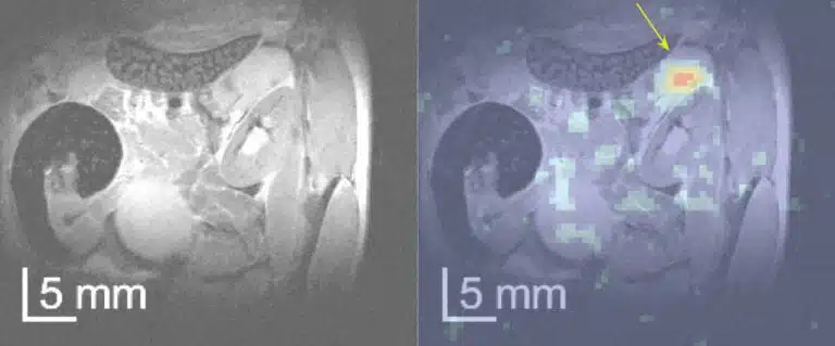 סריקת MRI רגילה אינה מסוגלת לזהות גידול בלבלב (משמאל). לאחר הזרקת סוכר מהונדס ושיפור הרגישות של הסריקה, הגידול מופיע בבירור בגישת ה-MRI החדשה שפיתחו החוקרים (מימין)